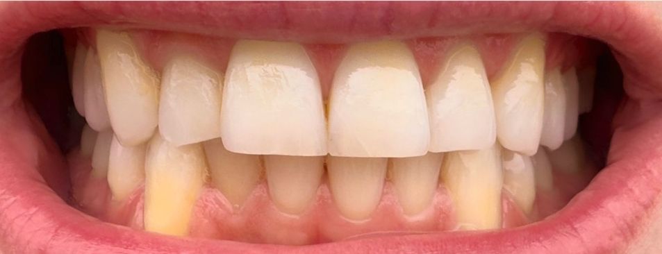 Smile before the treatment
