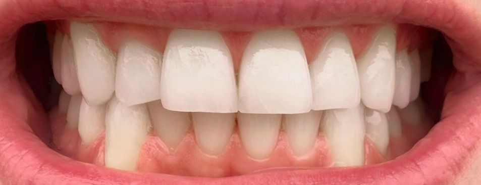 Smile after the treatment
